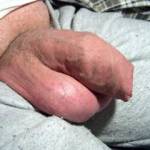 long foreskin