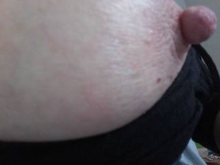 This is how Sally's nipple looked after the removal of the band.
