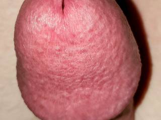Swollen meatus urethra open hole