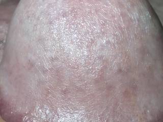 My glans 44 days after circumcision