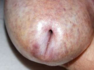 My lichen sclerosus head. it's not bad, it just looks different.