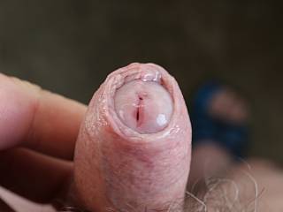 moving foreskin