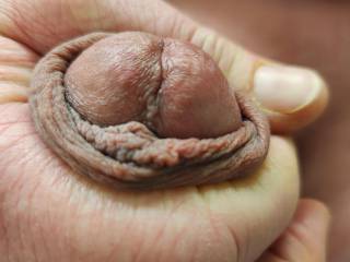 I appreciate that I have a loose circumcision